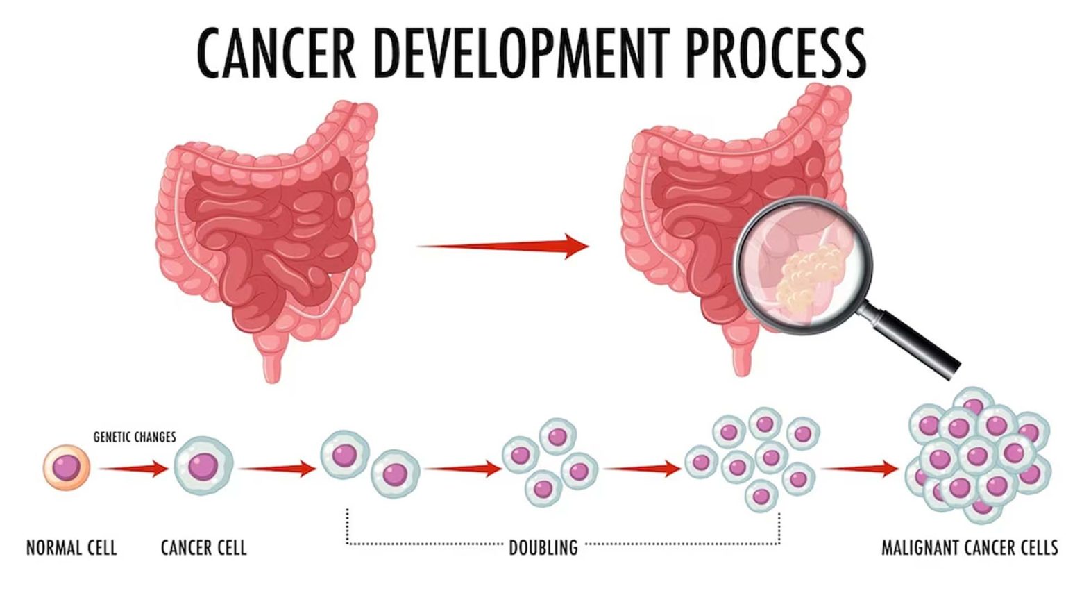 Colon Cancer Symptoms Stages Causes Risk Factors And Complications 2444