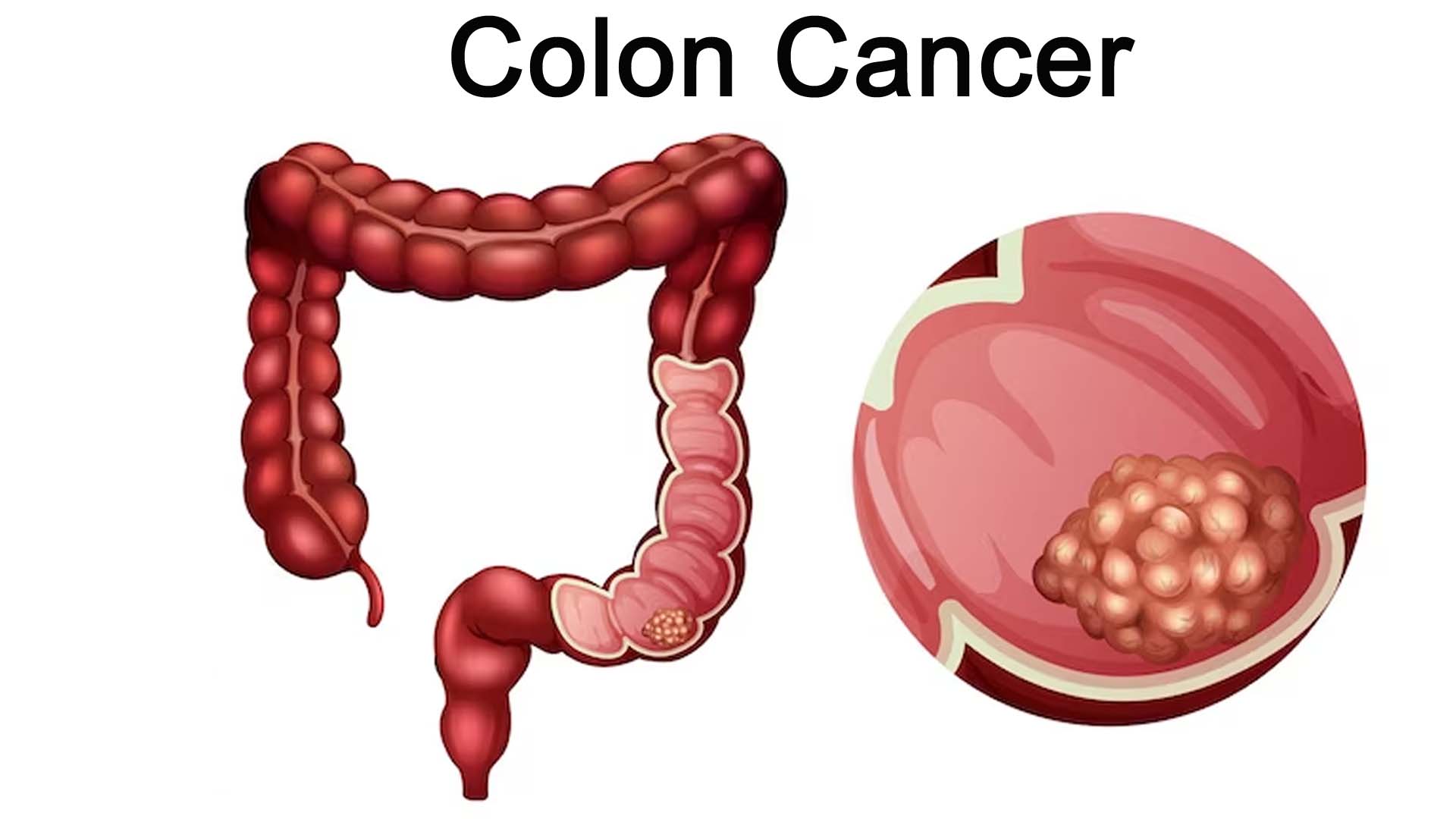 What Causes Colon Cancer in Females? – NutritionFact.in