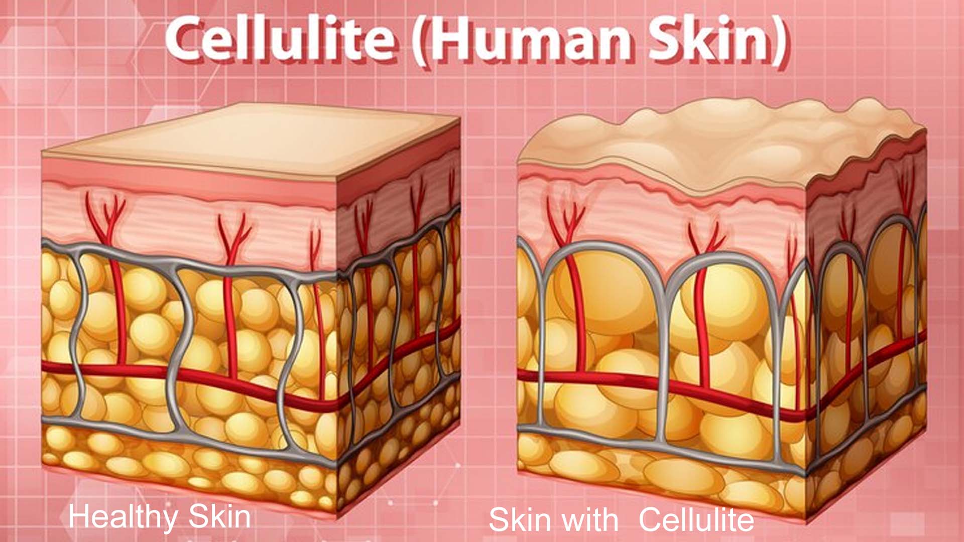 Cellulitis