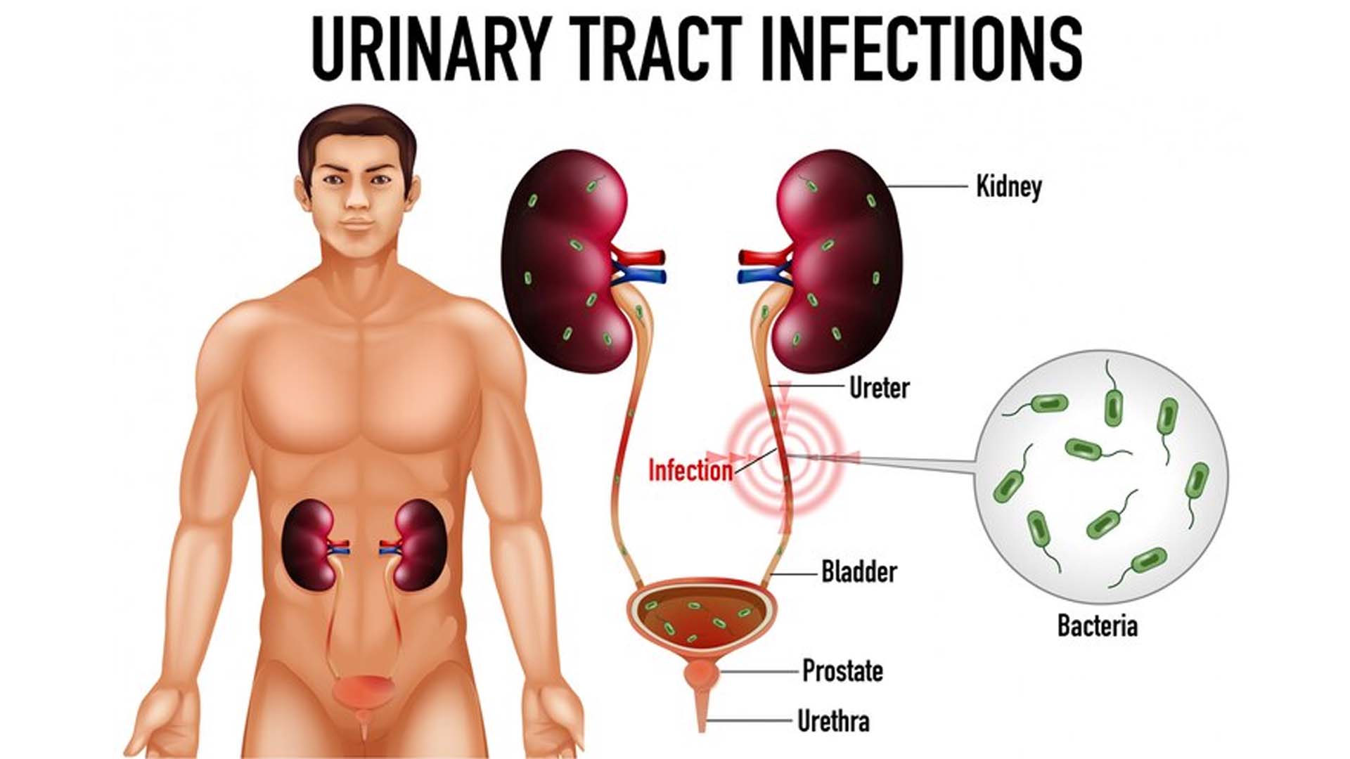 Urinary Tract Infections (UTIs) in males